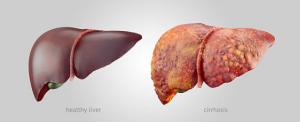 Healthy and diseased liver.